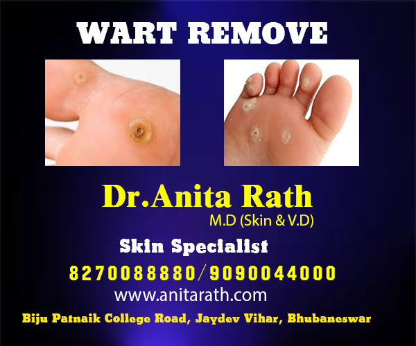 wart remove clinic in bhubaneswar, odisha